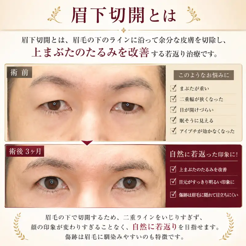 眉下切開モニター募集