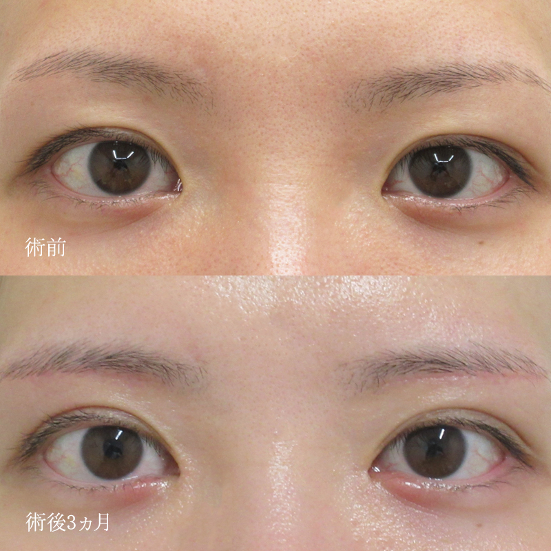 総院長竹江渉の眉下切開