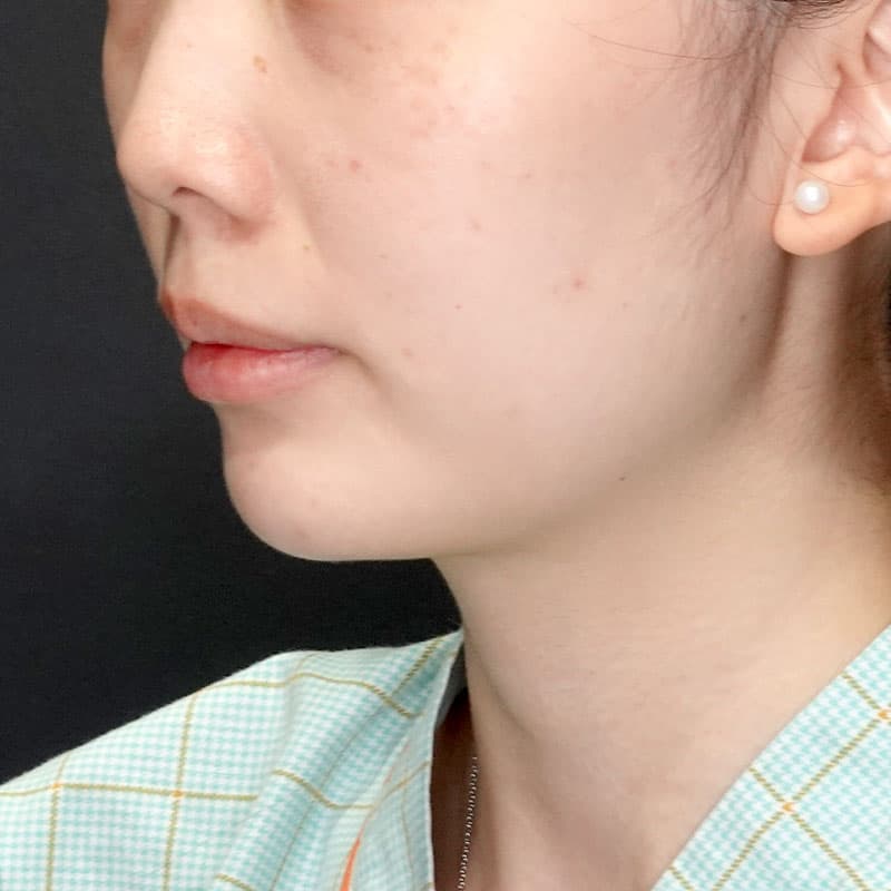 20260523_G105079_osada_face-liposuction_masseter-muscle-botox①Before