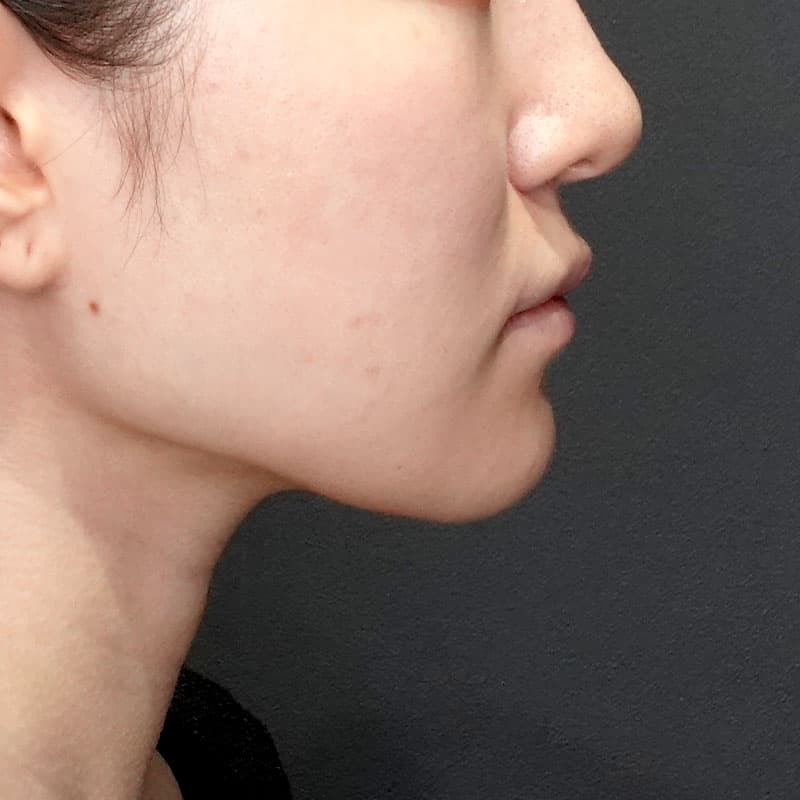20260523_G39656_takemura_face-liposuction_masseter-muscle-botox①After