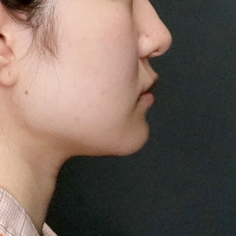 20260523_G39656_takemura_face-liposuction_masseter-muscle-botox①Before