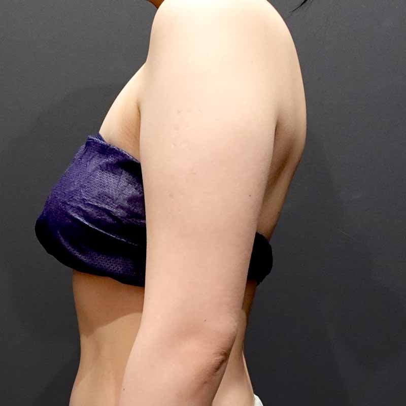 20260601_B148470_ishihara_arm-liposuction①Before