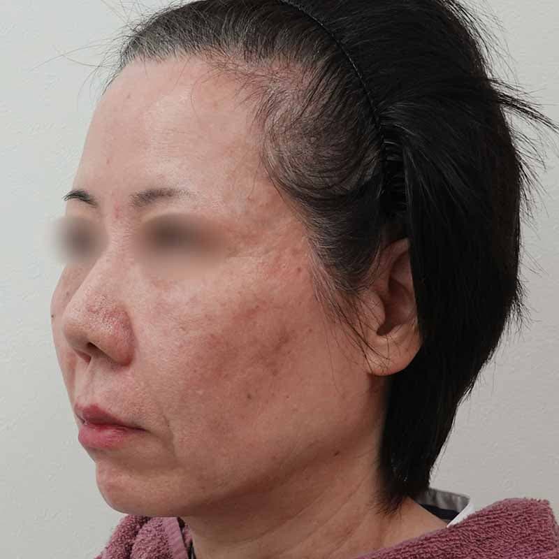 20260601_S156714_koito_hyaluronic acid lift①After