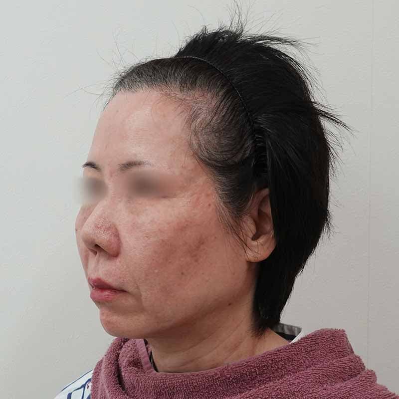 20260601_S156714_koito_hyaluronic acid lift①After
