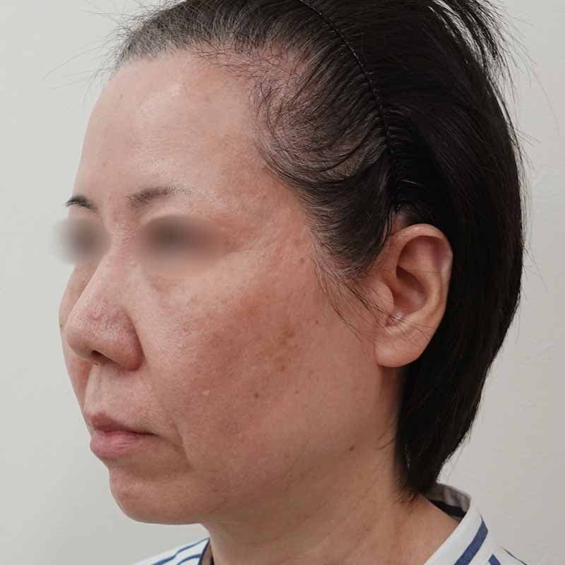 20260601_S156714_koito_hyaluronic acid lift①Before