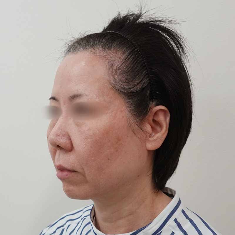 20260601_S156714_koito_hyaluronic acid lift①Before