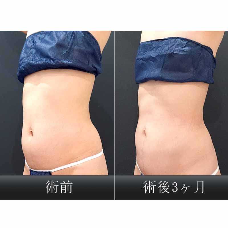 脂肪吸引 症例