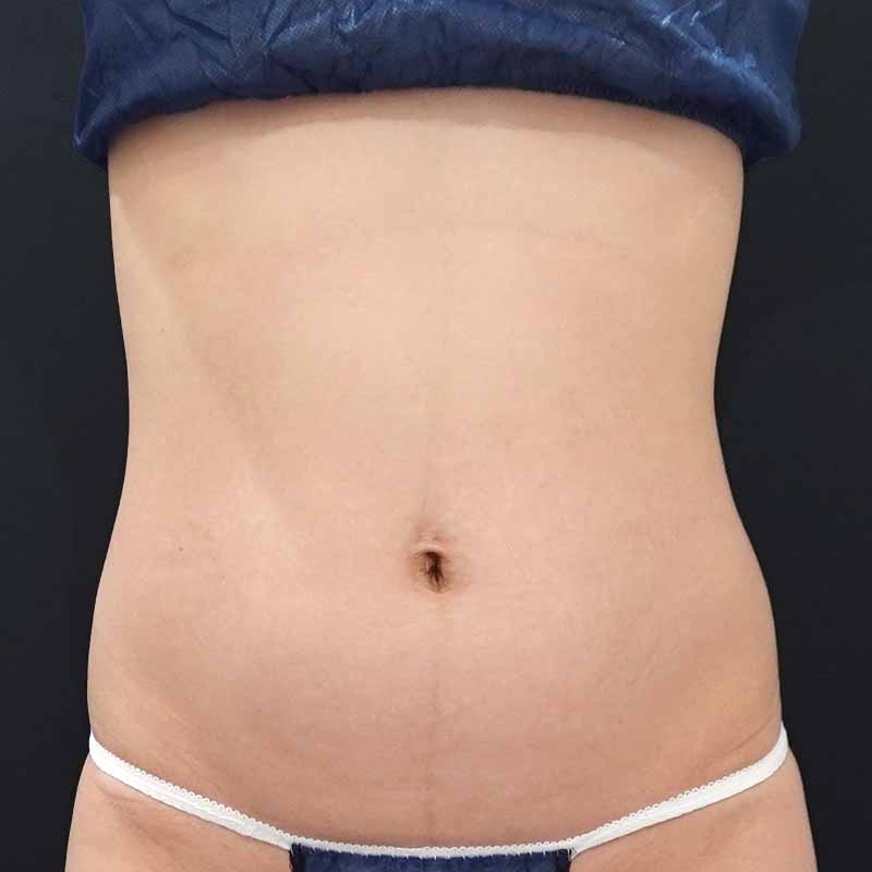 20260603_F6795_nagahama_stomach-liposuction②Before