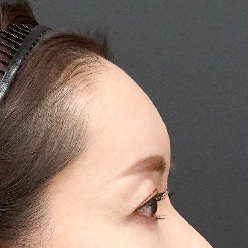 202606060_H156763_hosono_hyaluronic forehead- temples①After