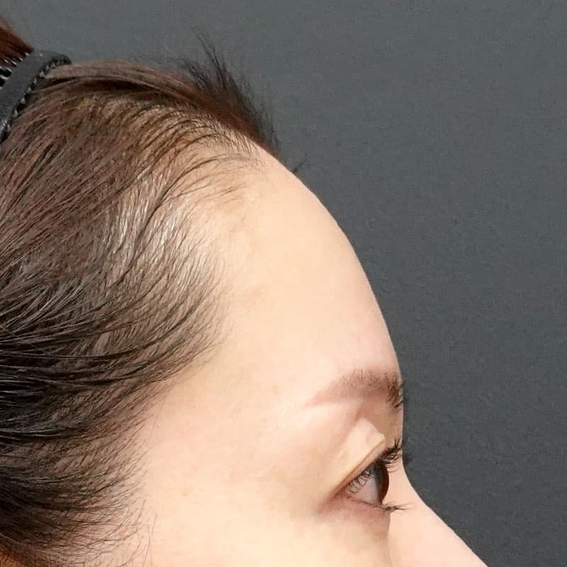 202606060_H156763_hosono_hyaluronic forehead- temples①Before