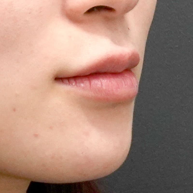 20260606_H156728_hosono_hyaluronic lips①After