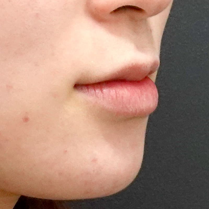 20260606_H156728_hosono_hyaluronic lips①Before