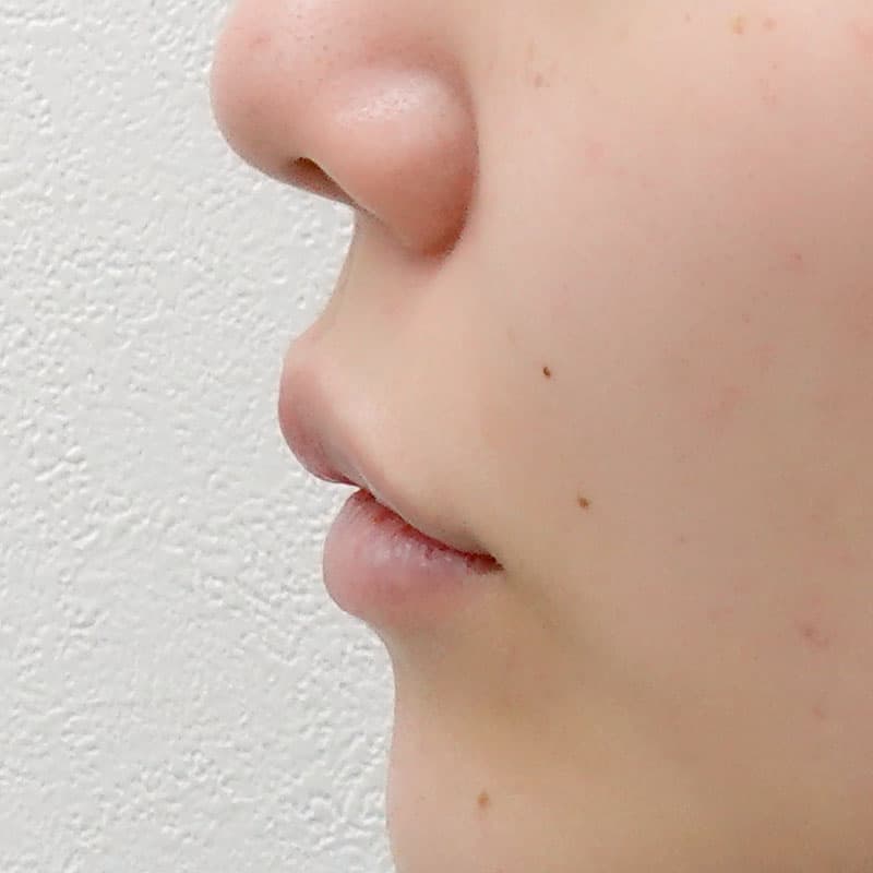 20260606_N126455_ono_hyaluronic lips-nasolabial folds①After