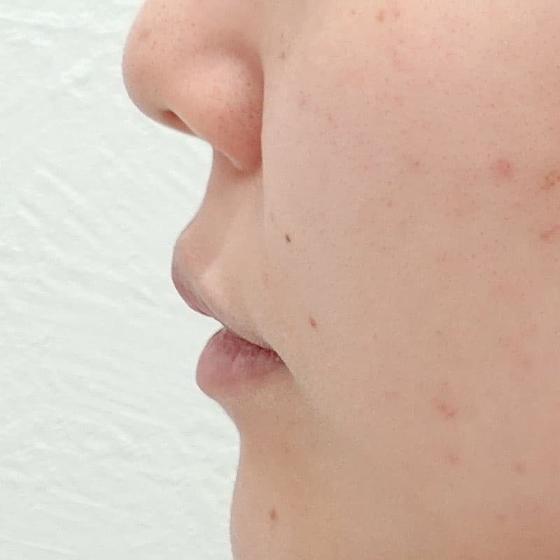 20260606_N126455_ono_hyaluronic lips-nasolabial folds①Before