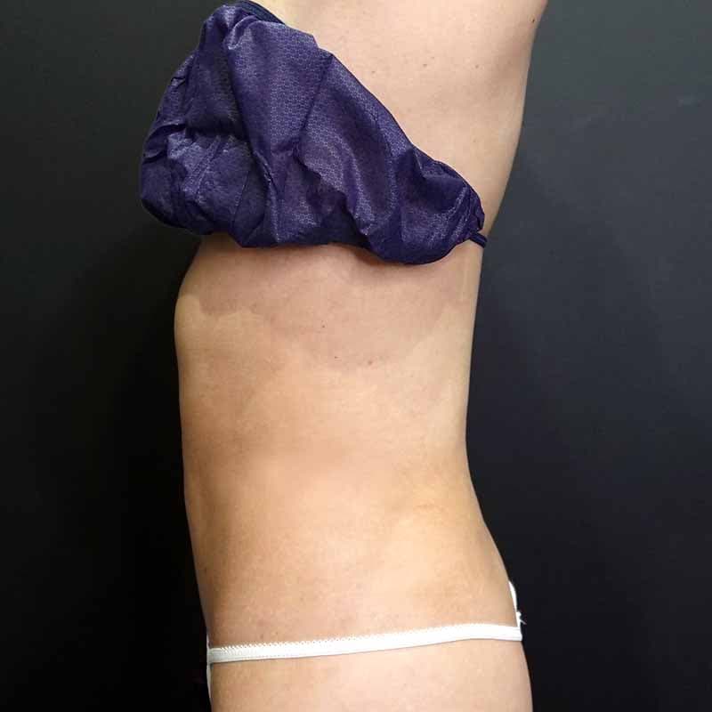 20260608_G156474_ishihara_stomach-liposuction ①After