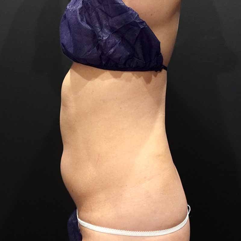 20260608_G156474_ishihara_stomach-liposuction ①Before