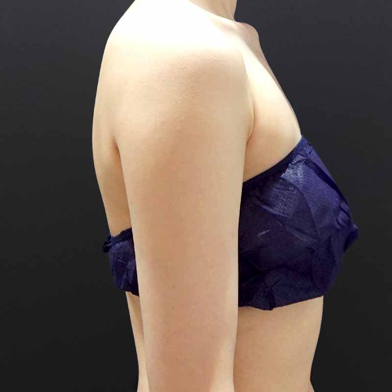 20260608_G19823_furumura_arm-liposuction①After