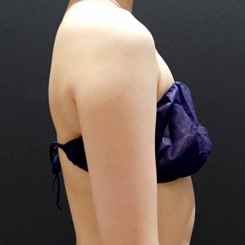 20260608_G19823_furumura_arm-liposuction①Before