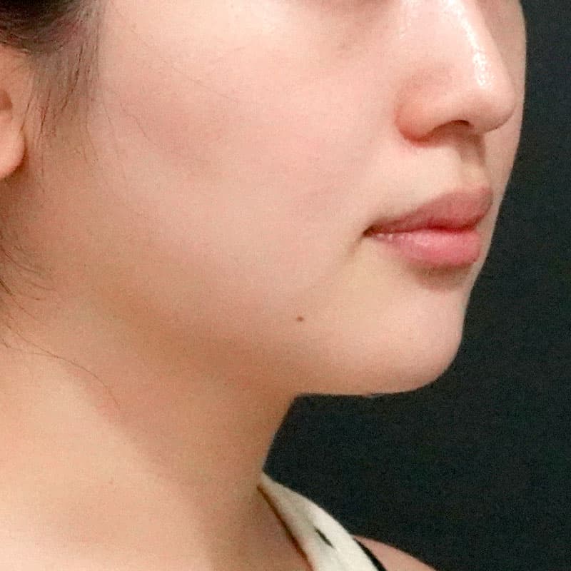 20260609_O125203_sato_face-liposuction_masseter-muscle-botox①After