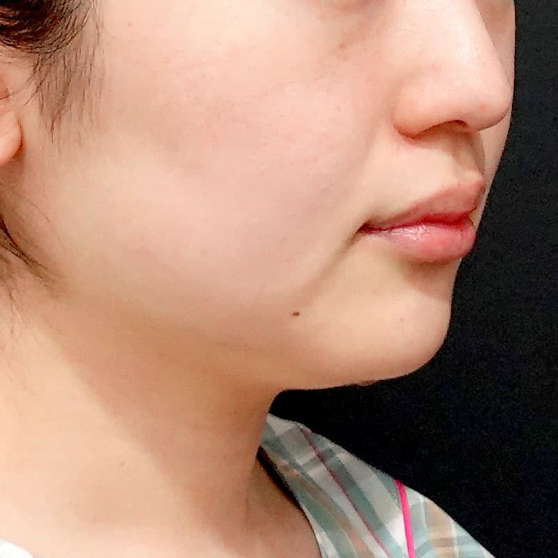 20260609_O125203_sato_face-liposuction_masseter-muscle-botox①Before
