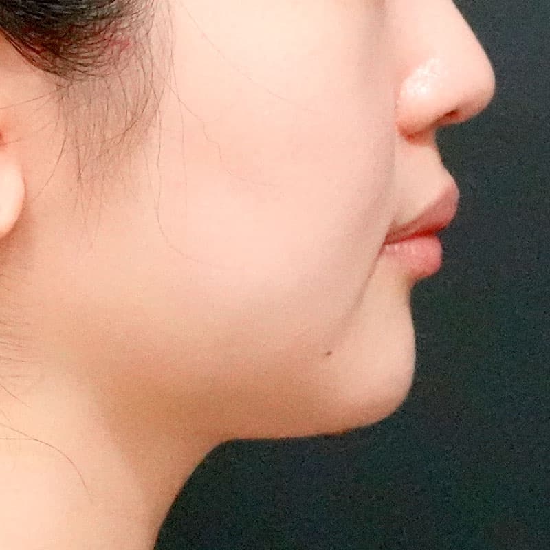 20260609_O125203_sato_face-liposuction_masseter-muscle-botox②After