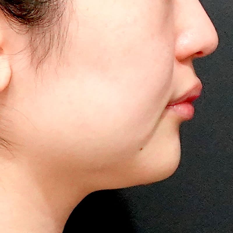 20260609_O125203_sato_face-liposuction_masseter-muscle-botox②Before