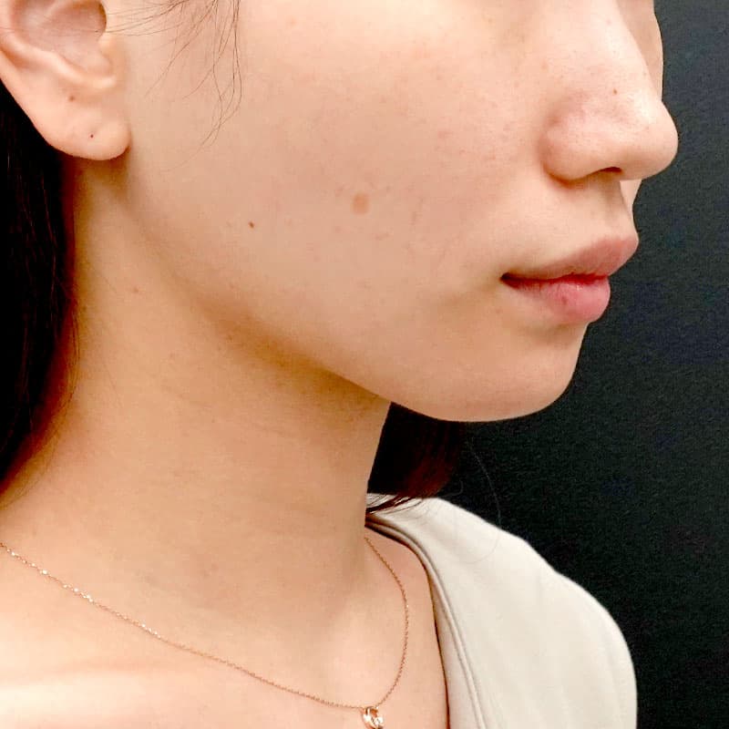 20260609_O141047_sato_face-liposuction_masseter-muscle-botox①After