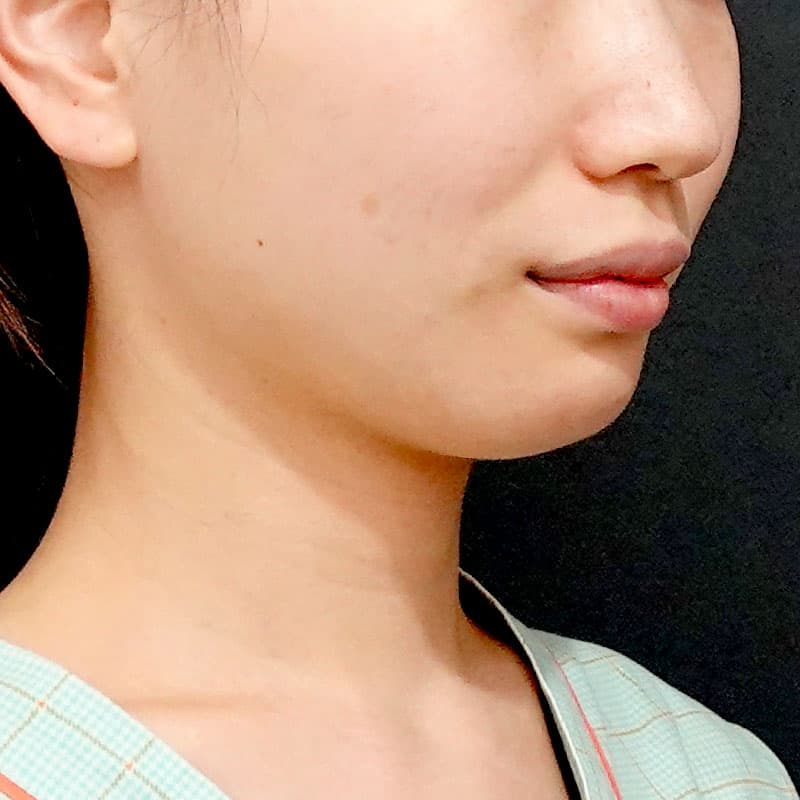 20260609_O141047_sato_face-liposuction_masseter-muscle-botox①Before