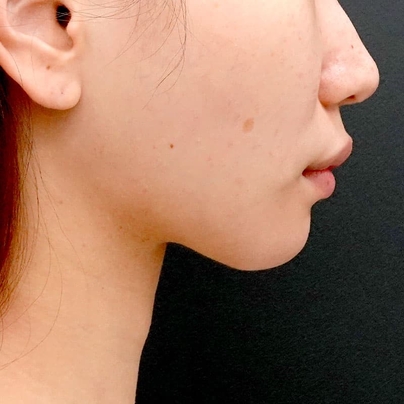 20260609_O141047_sato_face-liposuction_masseter-muscle-botox②After