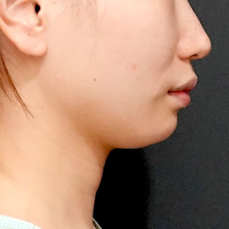20260609_O141047_sato_face-liposuction_masseter-muscle-botox②Before