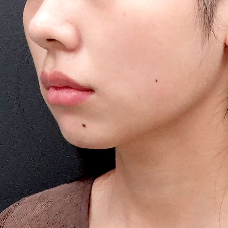 20260609_S15655_sato_face-liposuction_masseter-muscle-botox①After