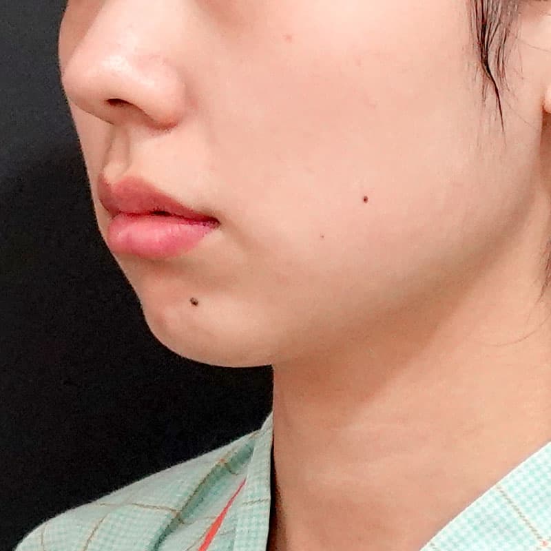 20260609_S15655_sato_face-liposuction_masseter-muscle-botox①Before