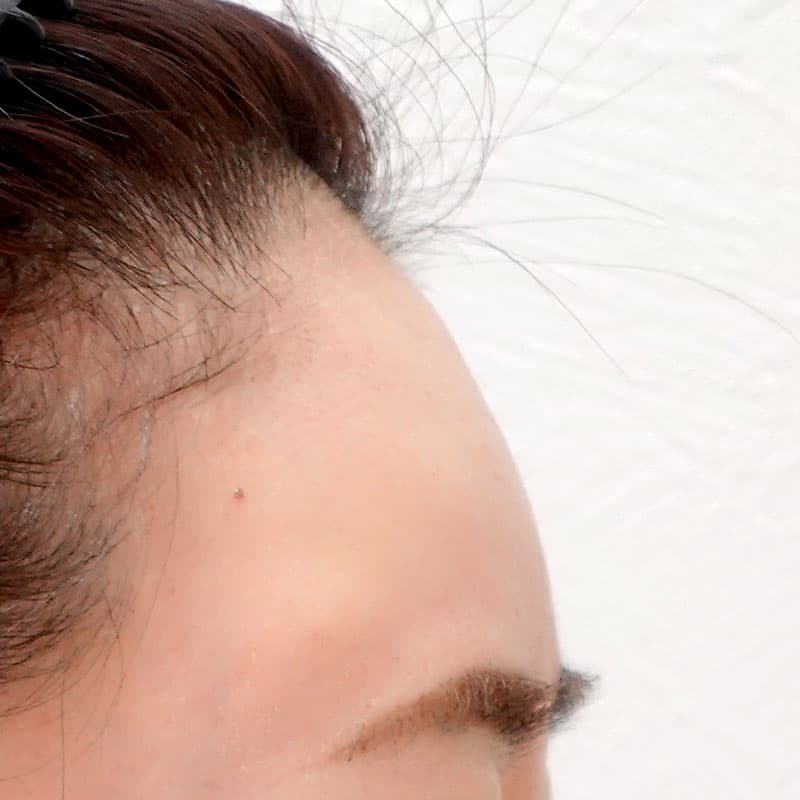 20260610_G34284_nagahama_hyaluronic forehead- temples①After