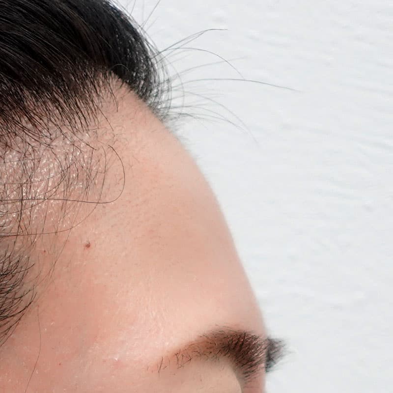 20260610_G34284_nagahama_hyaluronic forehead- temples①Before