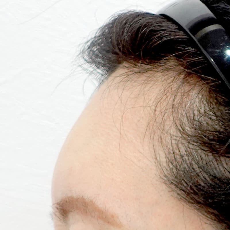 20260610_G35509_nagahama_hyaluronic forehead①After