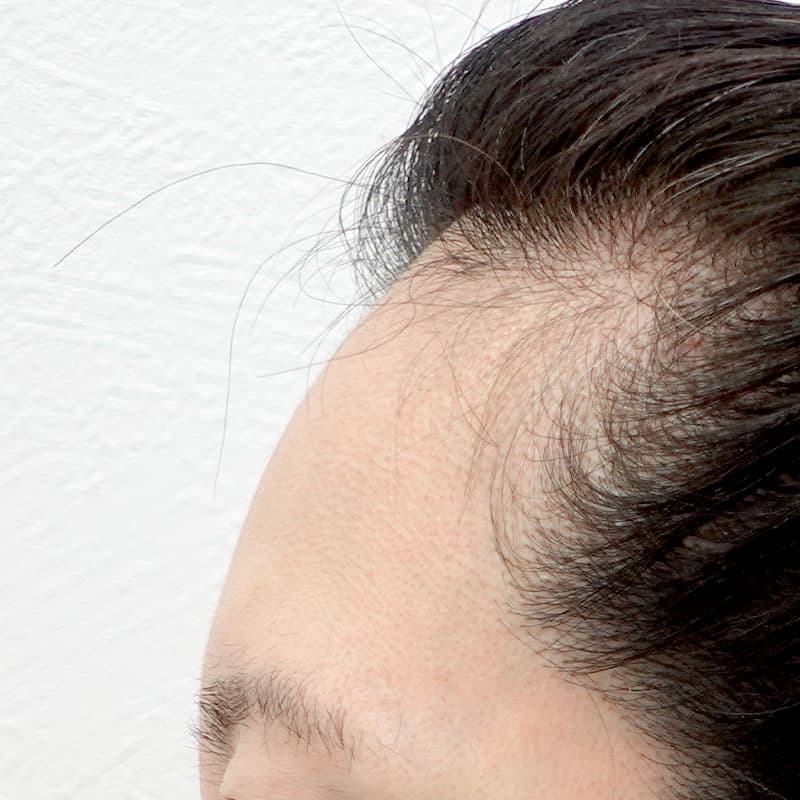 20260610_G35509_nagahama_hyaluronic forehead①Before