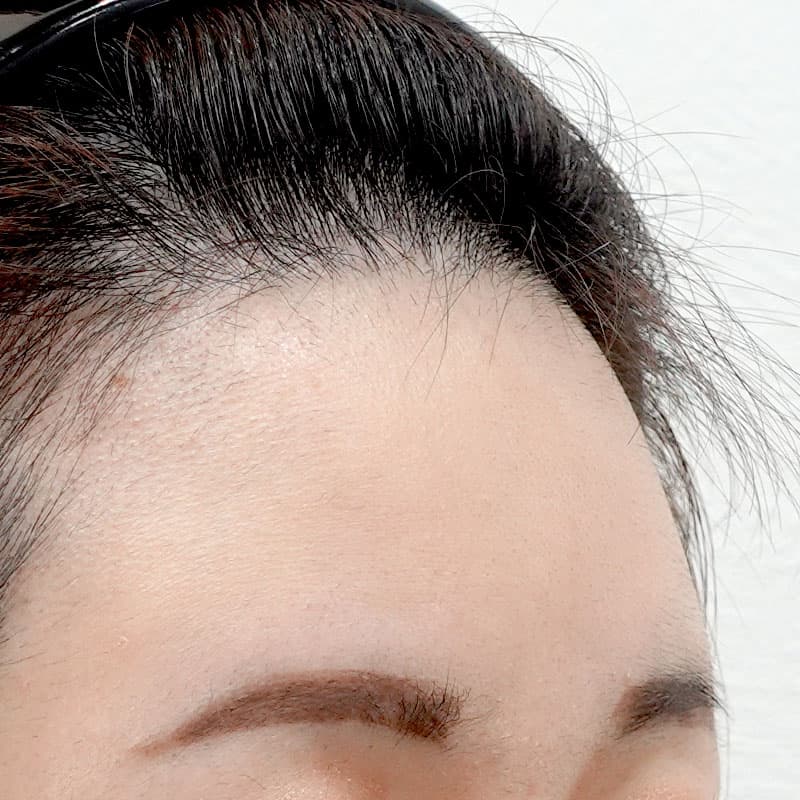 20260610_G36100_nagahama_hyaluronic forehead①After