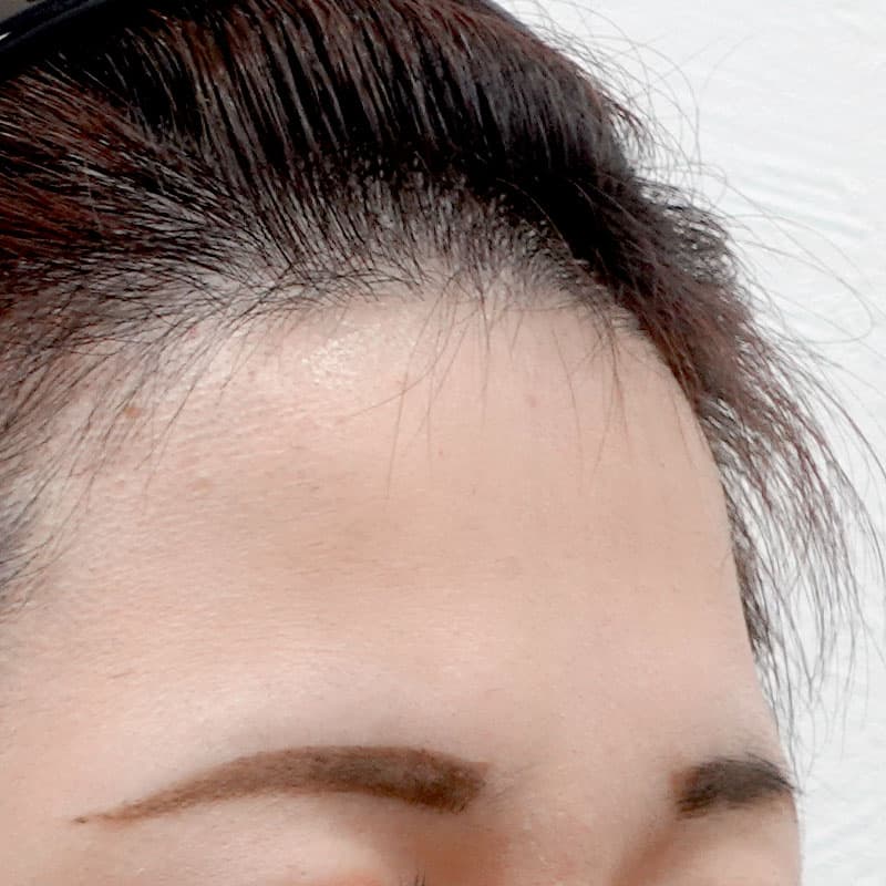 20260610_G36100_nagahama_hyaluronic forehead①Before