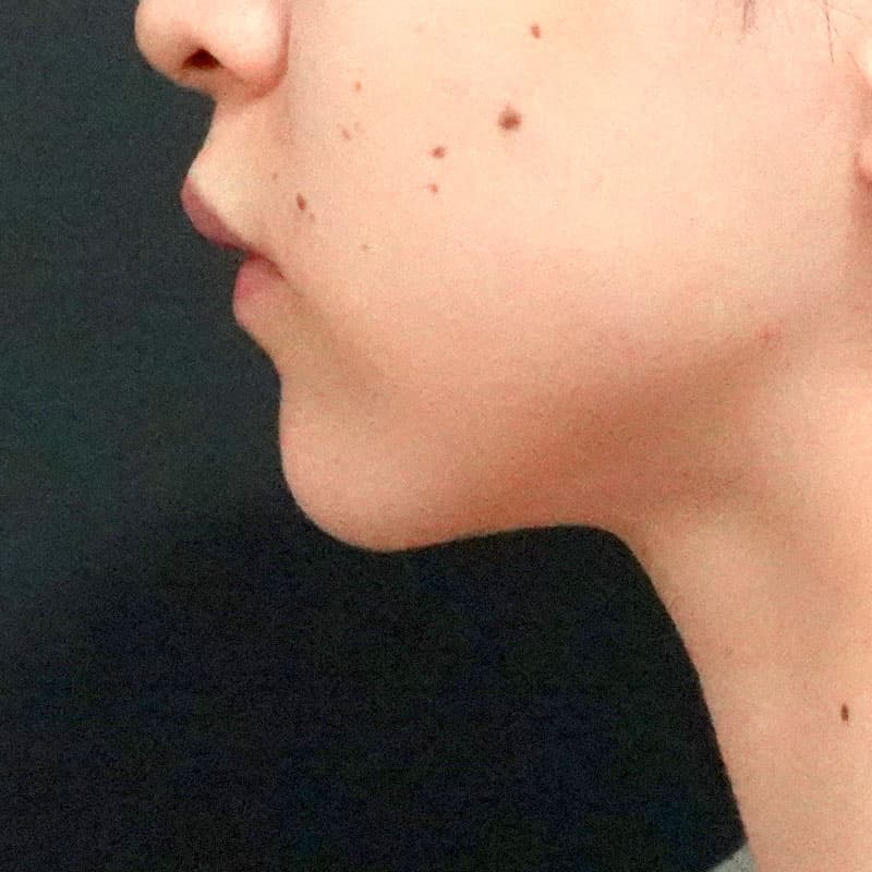 20260610_O119777_sato_face-liposuction_masseter-muscle-botox①After