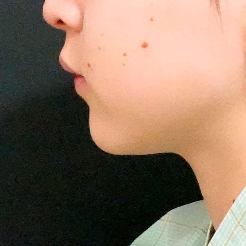 20260610_O119777_sato_face-liposuction_masseter-muscle-botox①Before