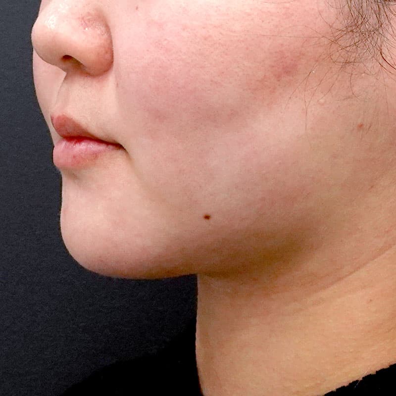 20260610_O122441_sato_face-liposuction_masseter-muscle-botox①After
