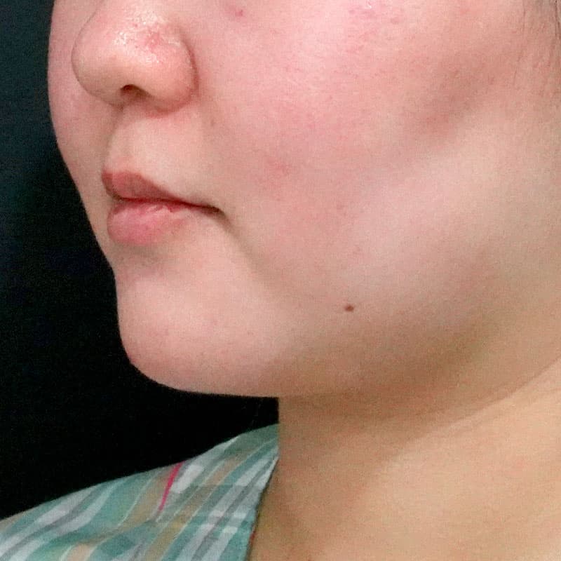 20260610_O122441_sato_face-liposuction_masseter-muscle-botox①Before