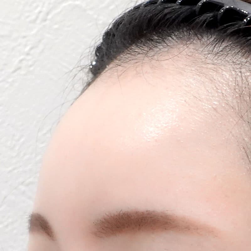 20260610_O13891_nagahama_hyaluronic forehead①After