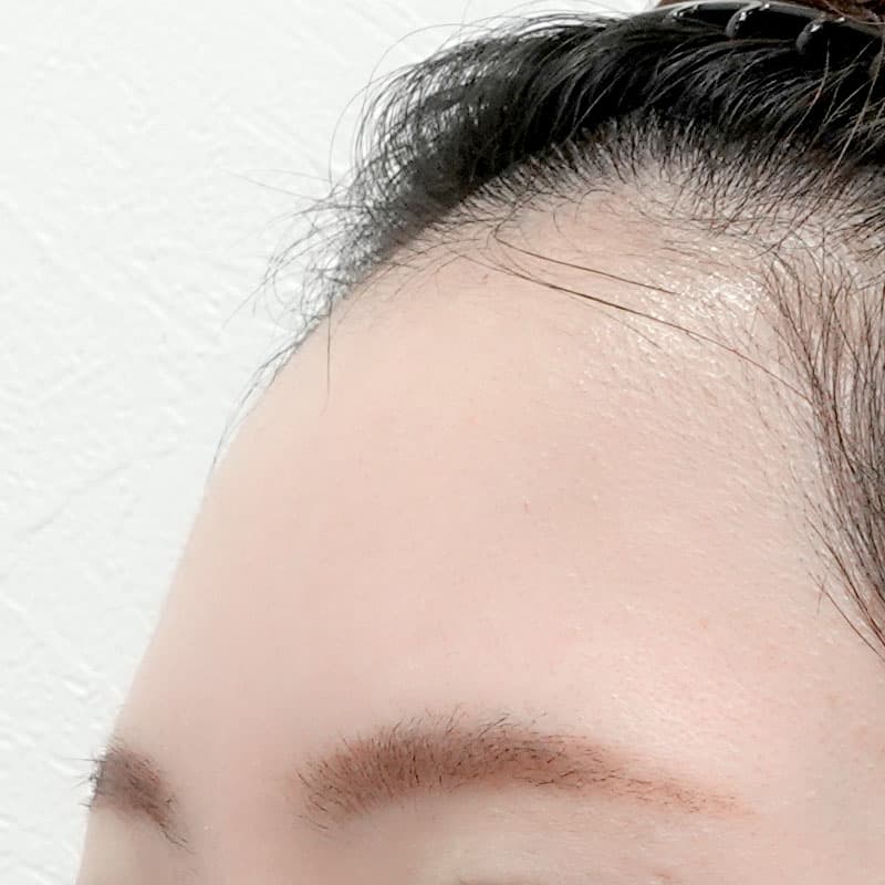 20260610_O13891_nagahama_hyaluronic forehead①Before
