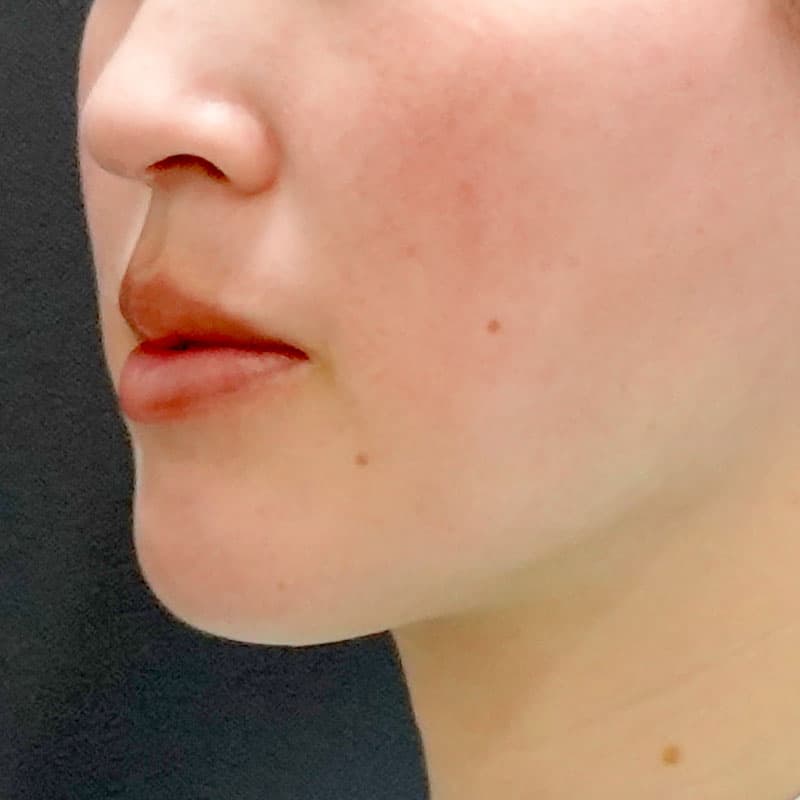 20260610_O35142_sato_face-liposuction_masseter-muscle-botox①After