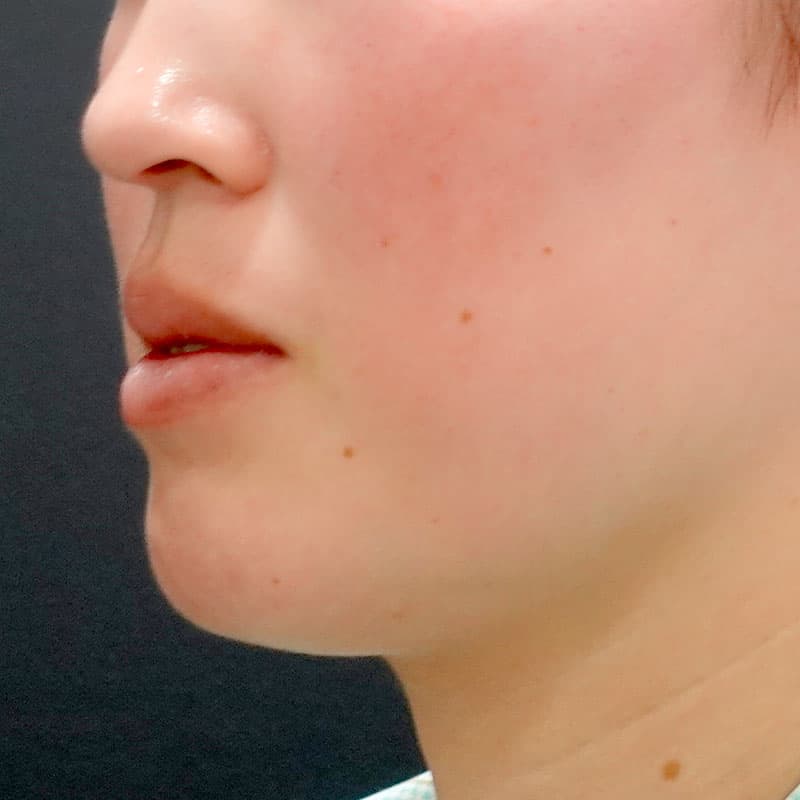 20260610_O35142_sato_face-liposuction_masseter-muscle-botox①Before