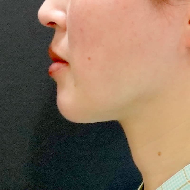 20260610_O35142_sato_face-liposuction_masseter-muscle-botox②After