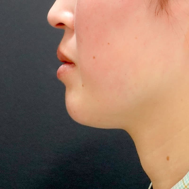 20260610_O35142_sato_face-liposuction_masseter-muscle-botox②Before
