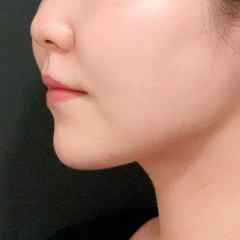 20260610_O37225_sato_face-liposuction_masseter-muscle-botox①After