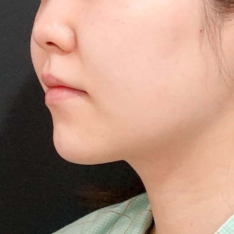 20260610_O37225_sato_face-liposuction_masseter-muscle-botox①Before